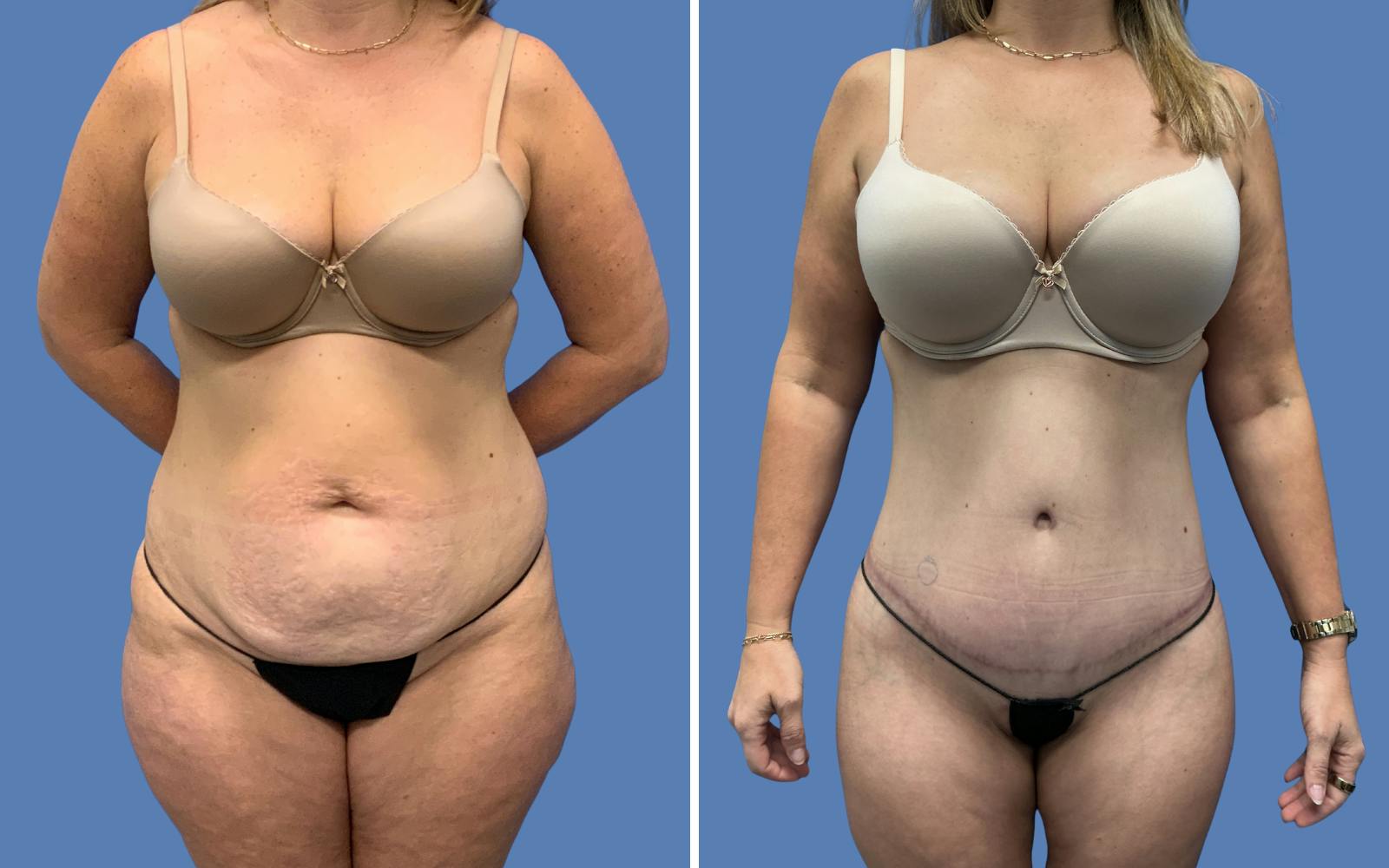 Abdominoplasty Before & After Gallery - Patient 501101 - Image 1