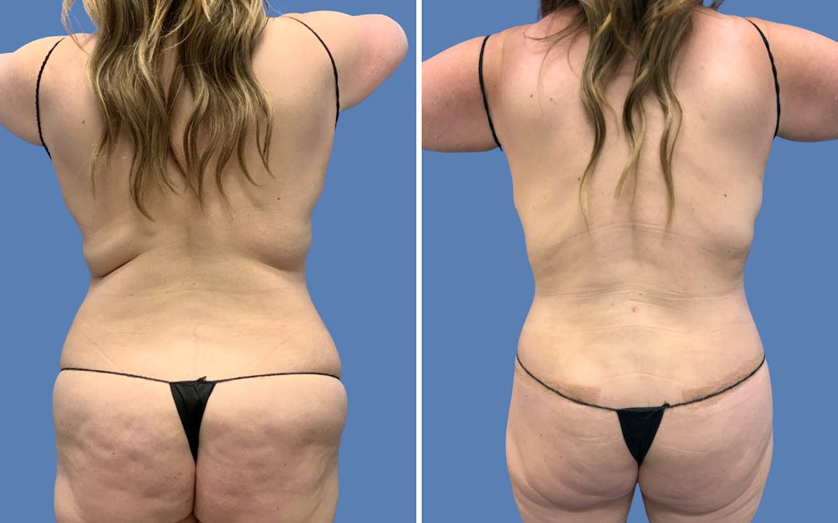 Abdominoplasty Before & After Gallery - Patient 127404 - Image 4