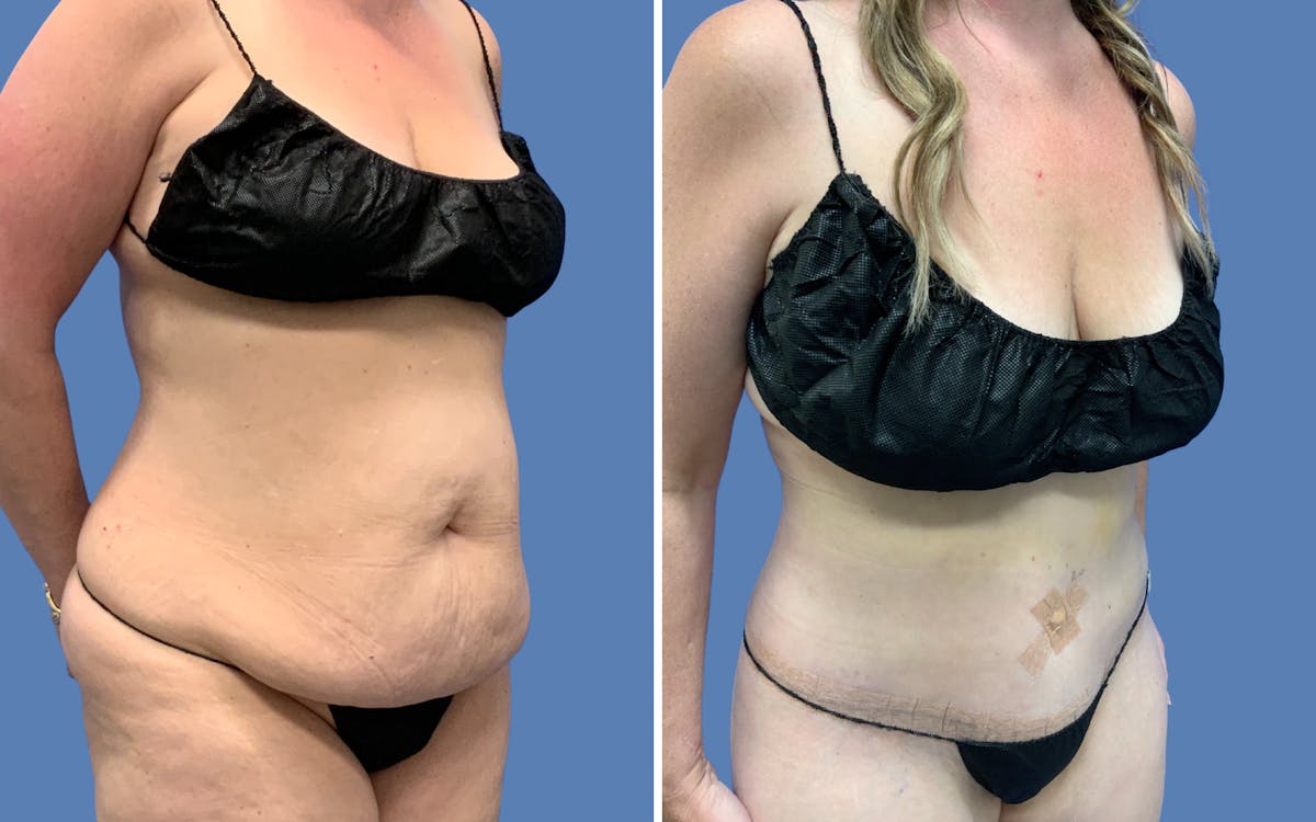 Abdominoplasty Before & After Gallery - Patient 127404 - Image 2