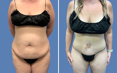 Abdominoplasty Before & After Gallery - Patient 127404 - Image 1