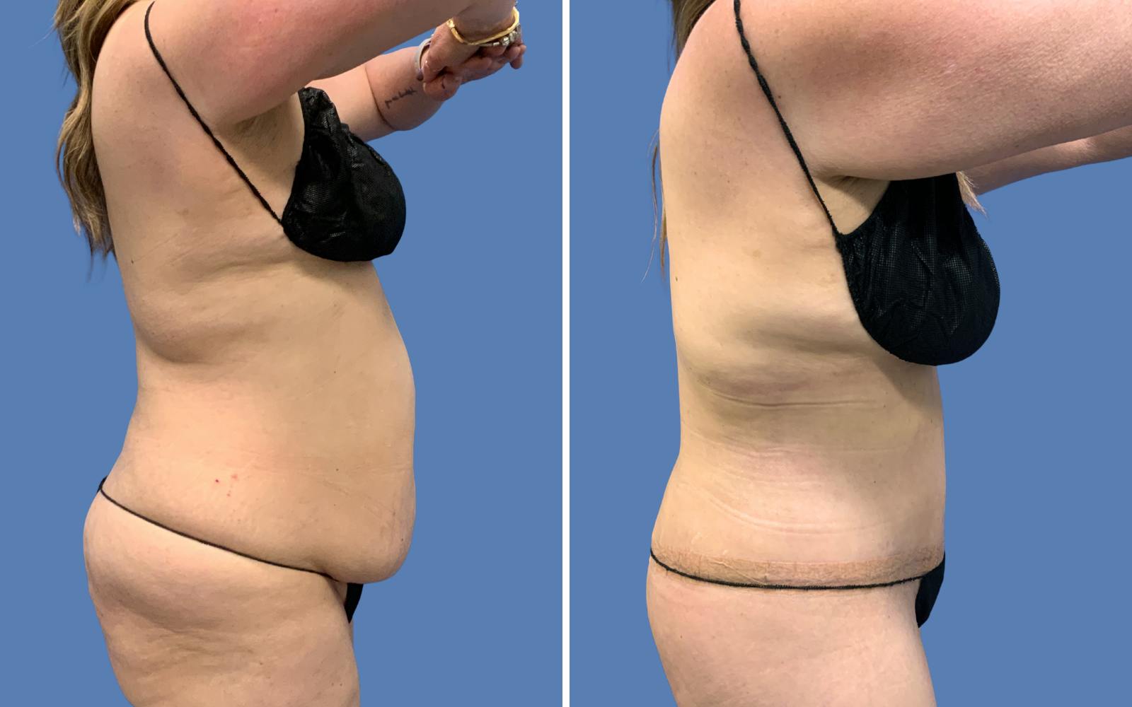 Abdominoplasty Before & After Gallery - Patient 127404 - Image 3