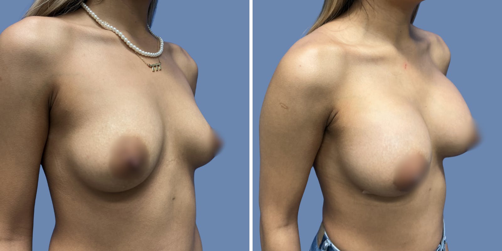 Breast Augmentation Before & After Gallery - Patient 292664 - Image 2