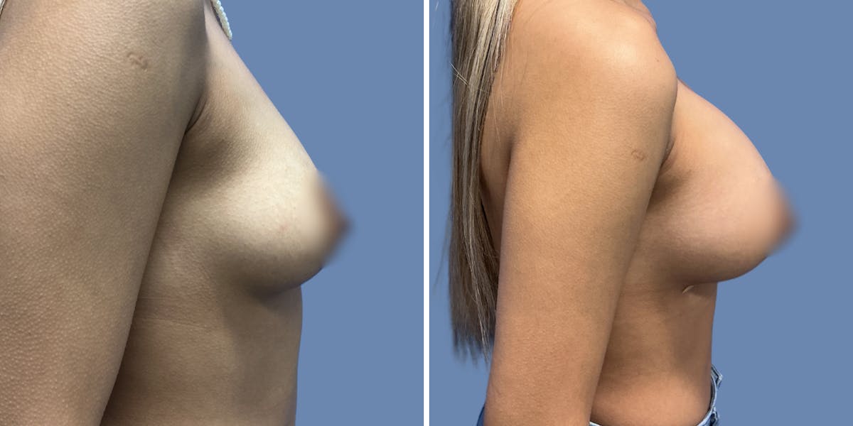 Breast Augmentation Before & After Gallery - Patient 292664 - Image 3
