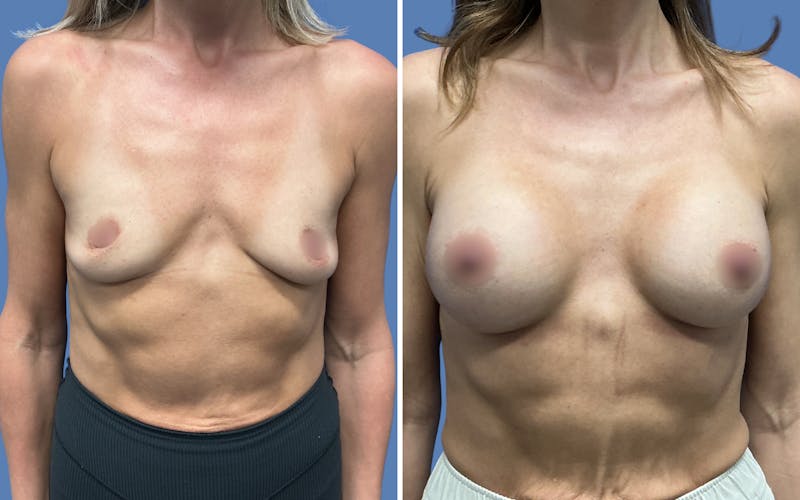 Patient TSnKXtLKQ-alxuqN34hgWg - Breast Augmentation Before & After Photos
