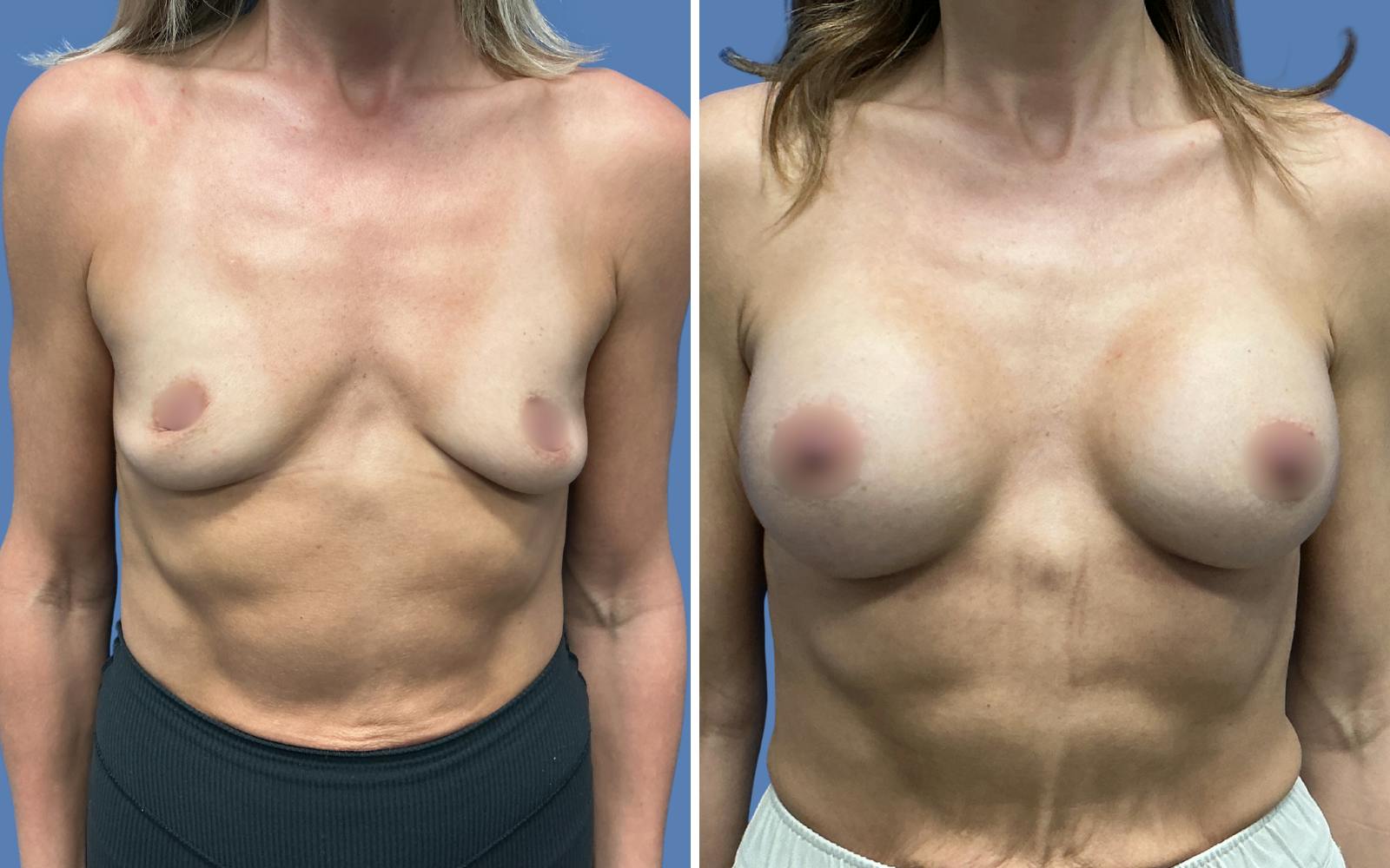 Breast Augmentation Before & After Gallery - Patient 115522 - Image 1