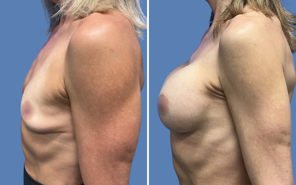 Breast Augmentation Before & After Gallery - Patient 115522 - Image 3