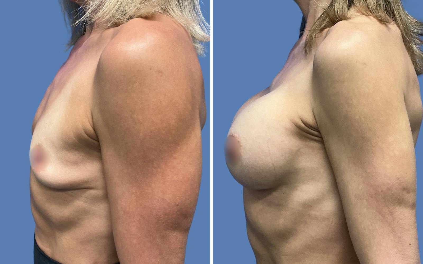 Breast Augmentation Before & After Gallery - Patient 115522 - Image 3