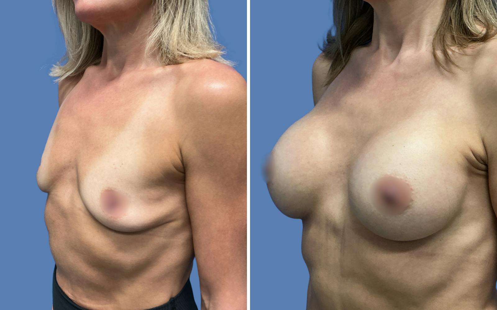 Breast Augmentation Before & After Gallery - Patient 115522 - Image 2