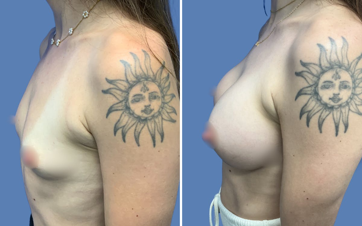 Breast Augmentation Before & After Gallery - Patient 364809 - Image 3