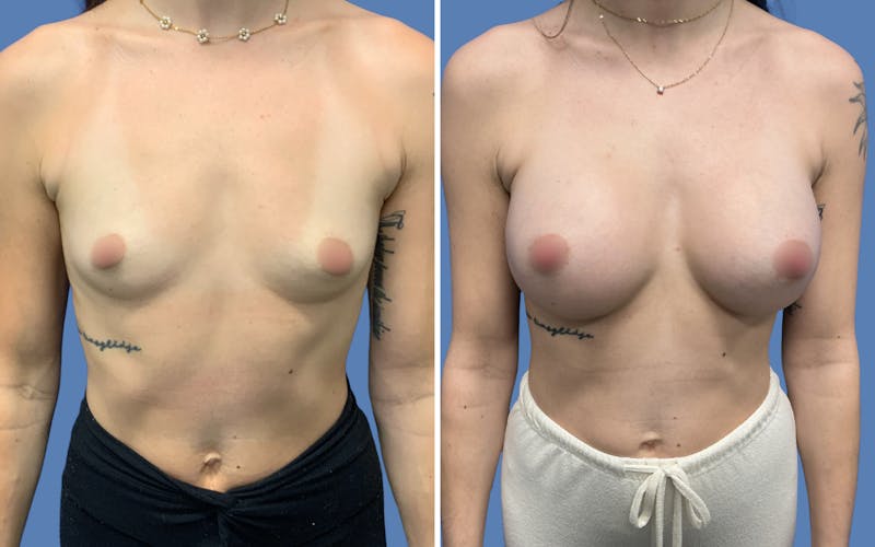 Patient F-s7sIa3RWeG7VnZ63niIA - Breast Augmentation Before & After Photos