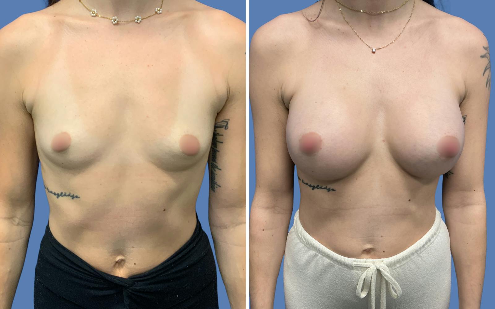 Breast Augmentation Before & After Gallery - Patient 364809 - Image 1