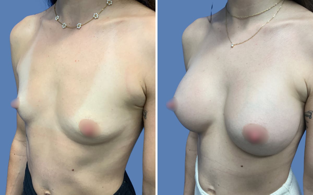 Breast Augmentation Before & After Gallery - Patient 364809 - Image 2
