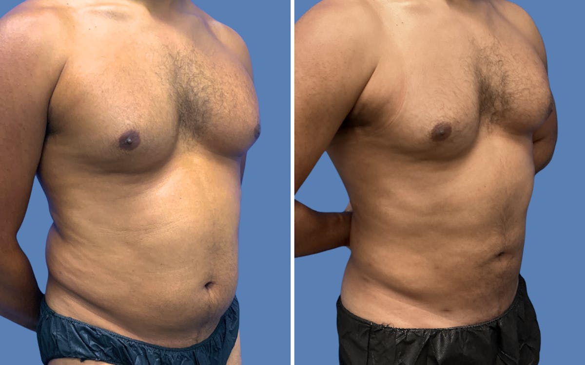 Liposuction Before & After Gallery - Patient 968569 - Image 2