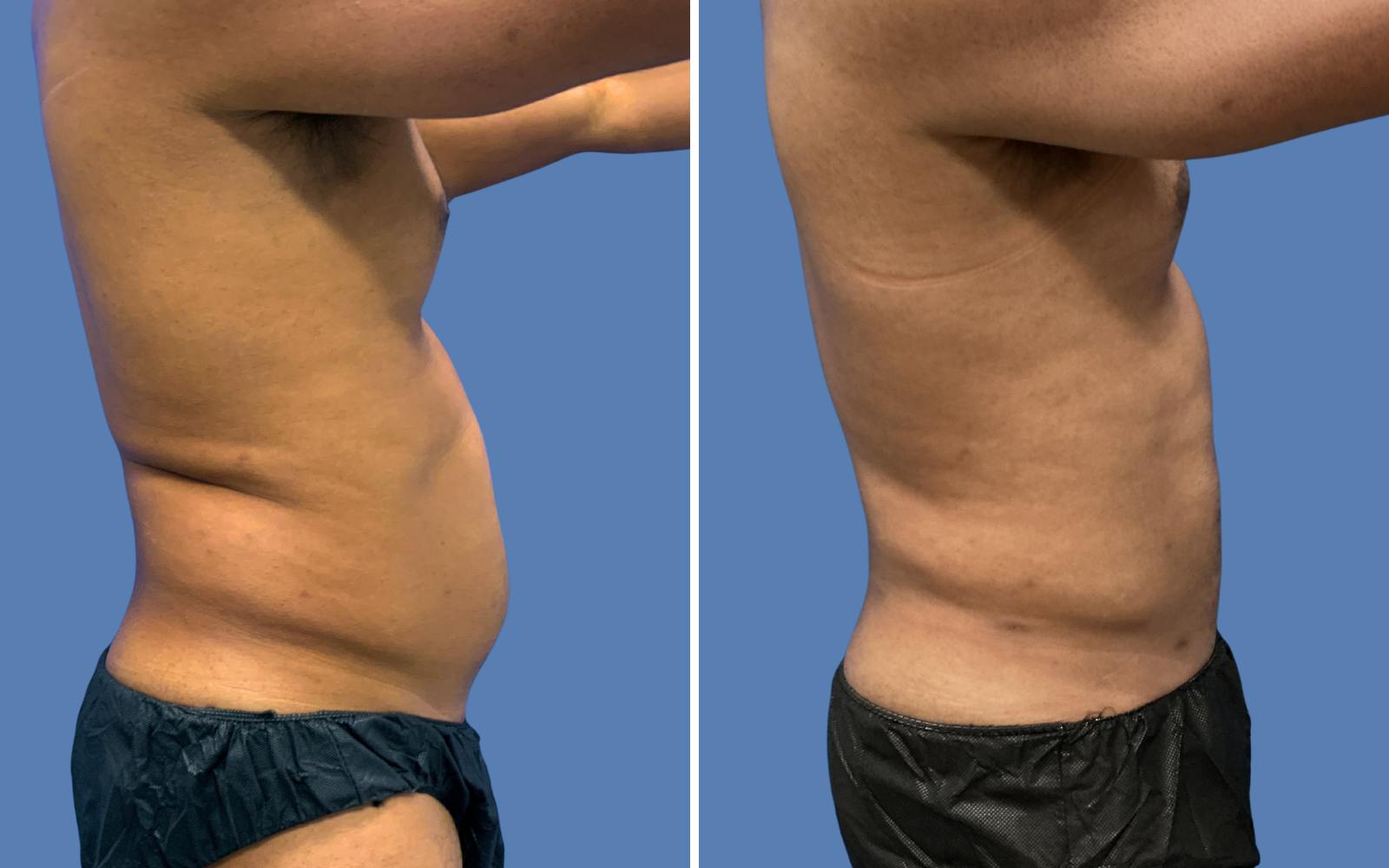 Liposuction Before & After Gallery - Patient 968569 - Image 3