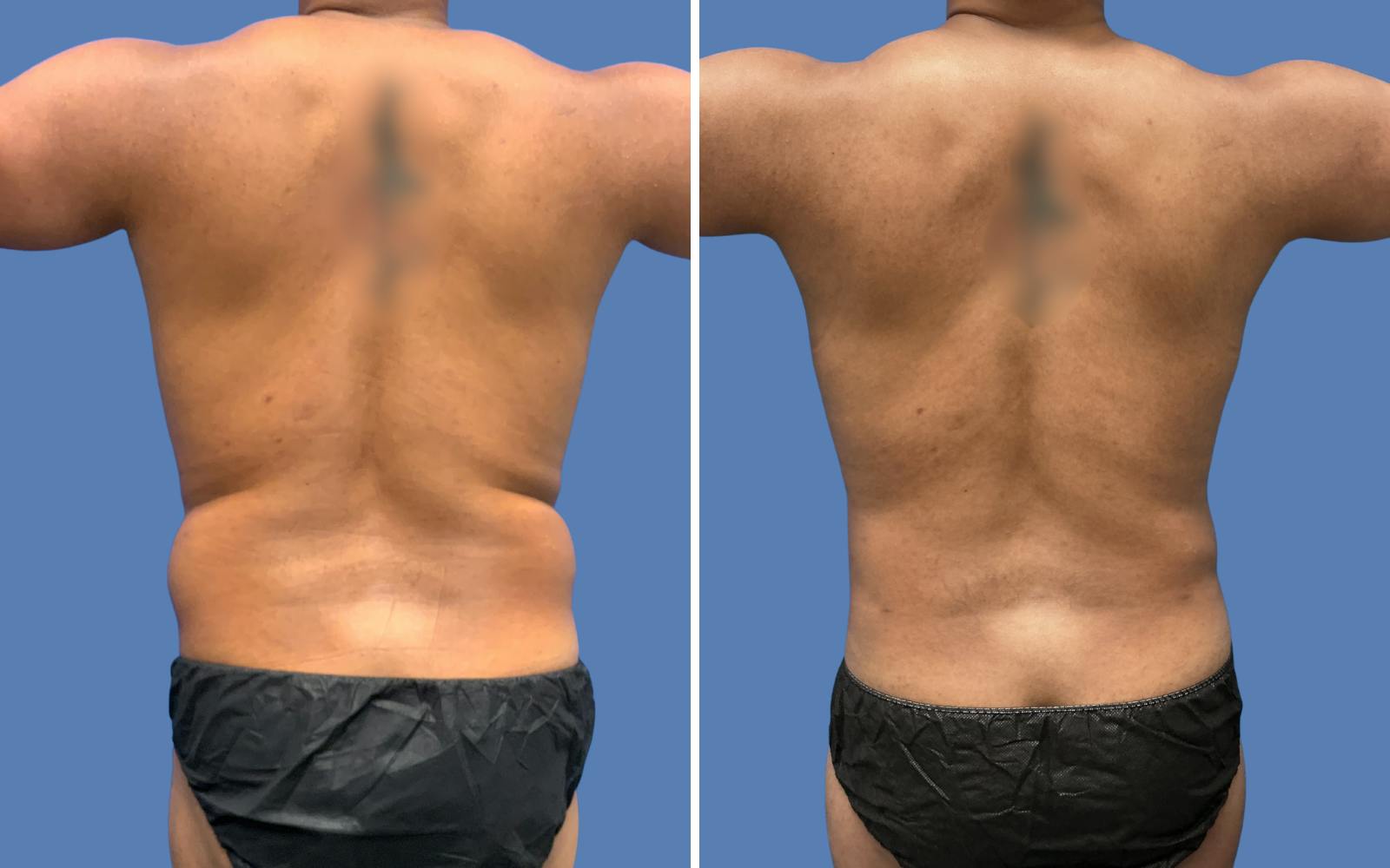 Liposuction Before & After Gallery - Patient 968569 - Image 4