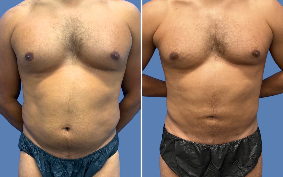 Liposuction Before & After Gallery - Patient 968569 - Image 1