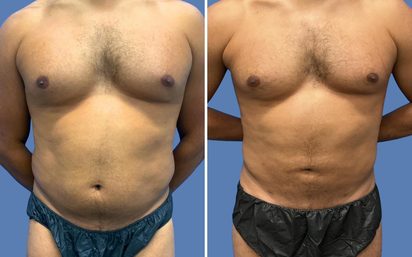 Liposuction Before & After Gallery - Patient 968569 - Image 1