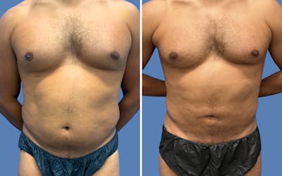 Liposuction Before & After Gallery - Patient 968569 - Image 1