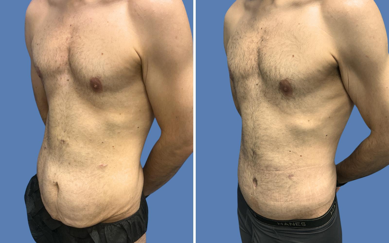 Body Lift Before & After Gallery - Patient 235637 - Image 2