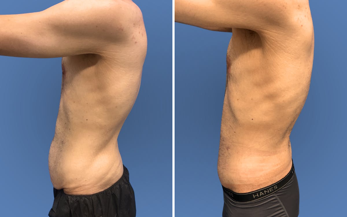 Body Lift Before & After Gallery - Patient 235637 - Image 3