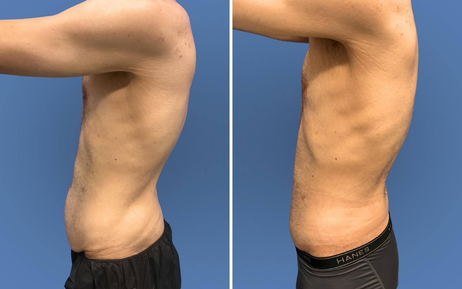 Body Lift Before & After Gallery - Patient 235637 - Image 3