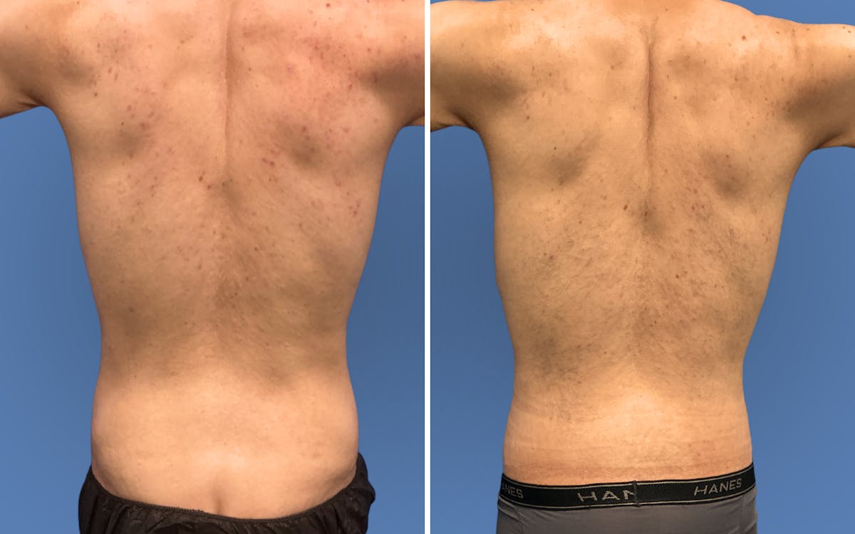 Body Lift Before & After Gallery - Patient 235637 - Image 4
