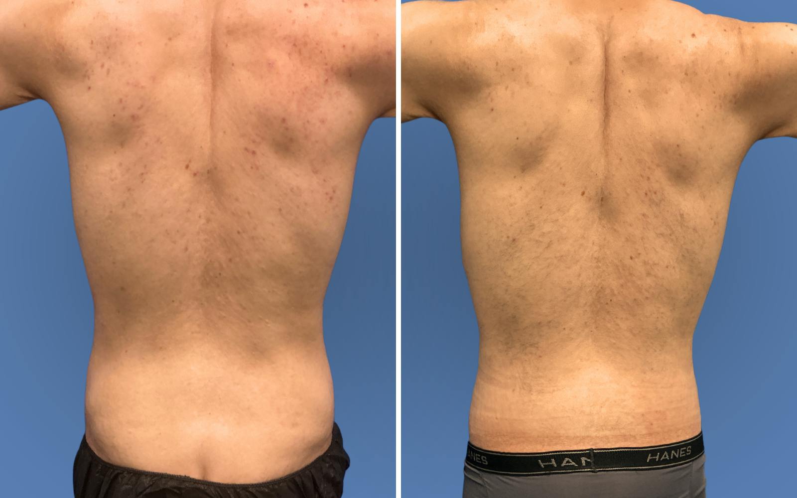 Body Lift Before & After Gallery - Patient 235637 - Image 4