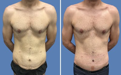 Body Lift Before & After Gallery - Patient 235637 - Image 1