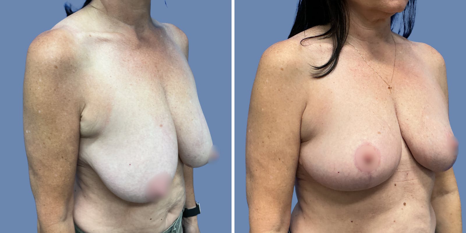 Breast Lift Before & After Gallery - Patient 329353 - Image 2