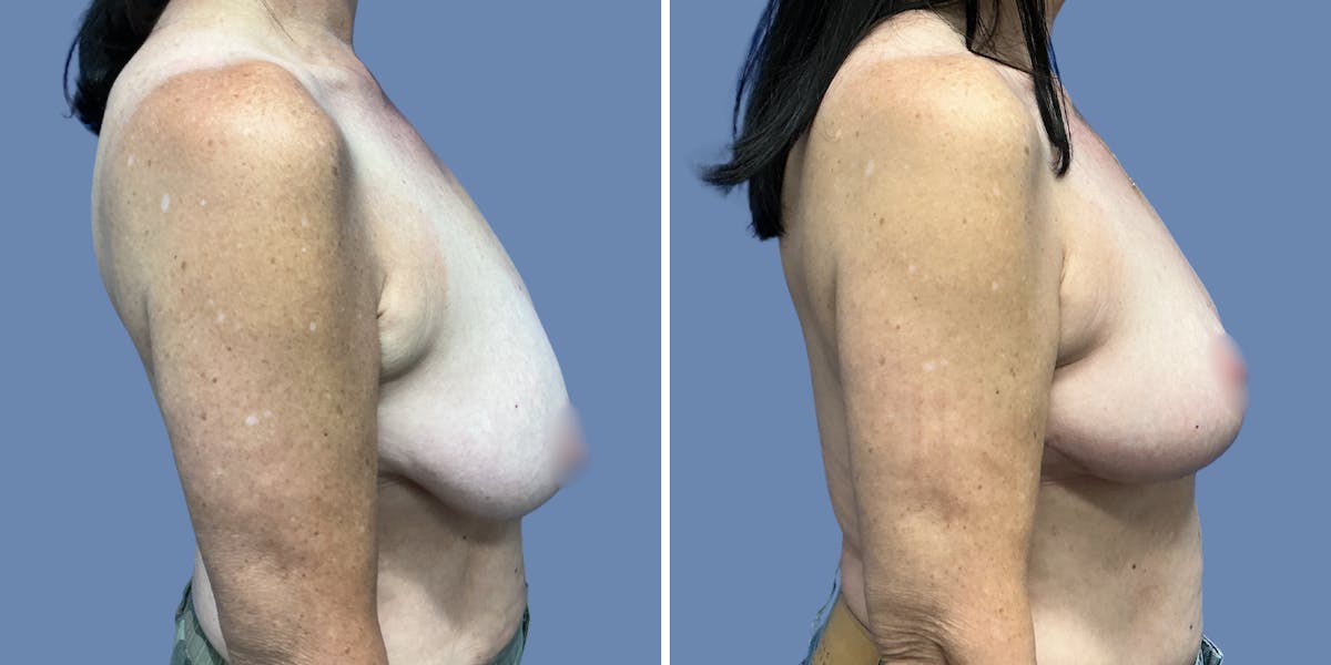 Breast Lift Before & After Gallery - Patient 329353 - Image 3