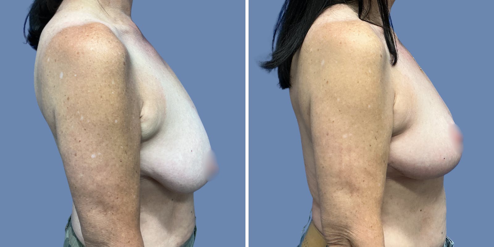 Breast Lift Before & After Gallery - Patient 329353 - Image 3