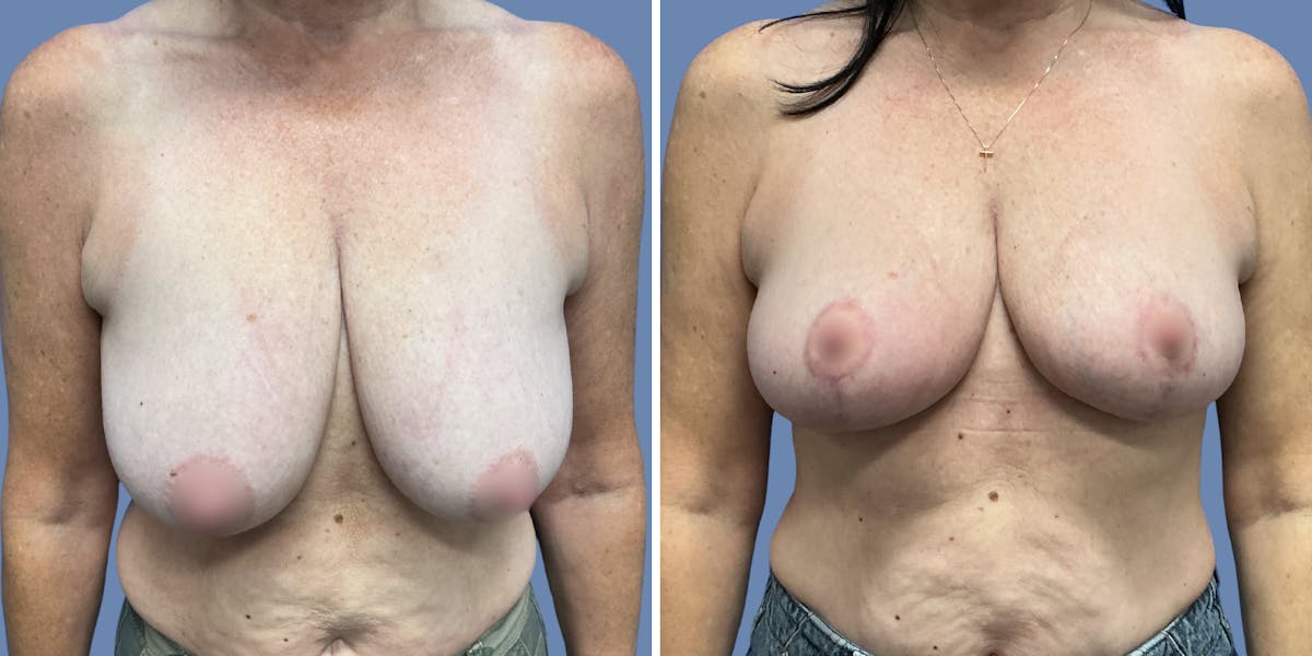 Breast Lift Before & After Gallery - Patient 329353 - Image 1