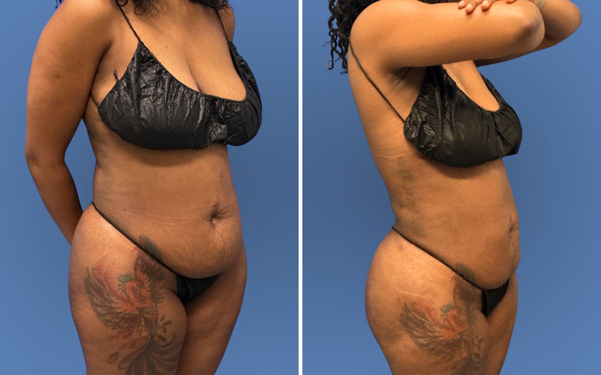 Fat Transfer Before & After Gallery - Patient 196019 - Image 2