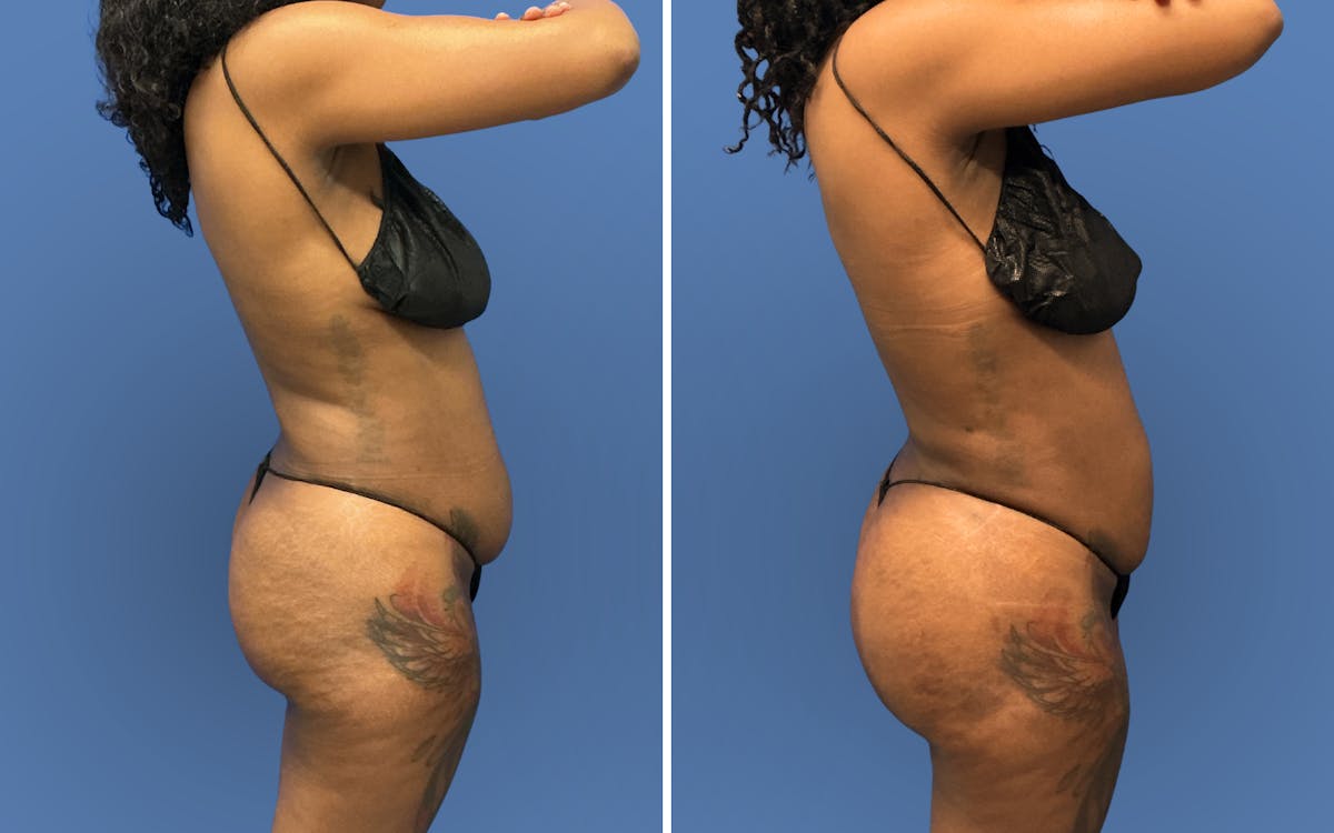 Fat Transfer Before & After Gallery - Patient 196019 - Image 3