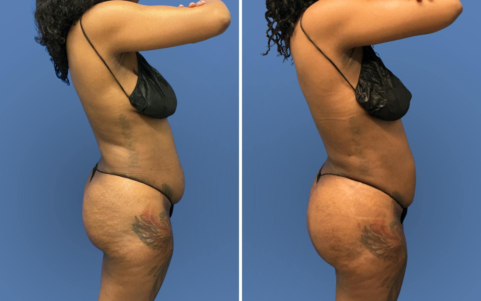 Brazilian Butt Lift Before & After Gallery - Patient 227790 - Image 4