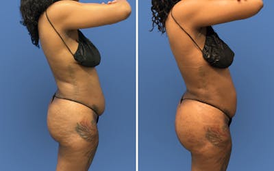 Fat Transfer Before & After Gallery - Patient 371059 - Image 1
