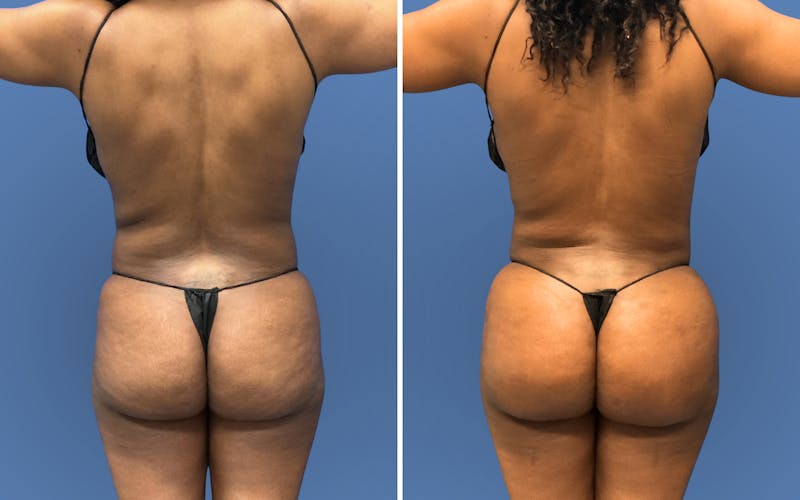 Patient X7NOgxDjRJq6aEtQHKcqAg - Liposuction Before & After Photos