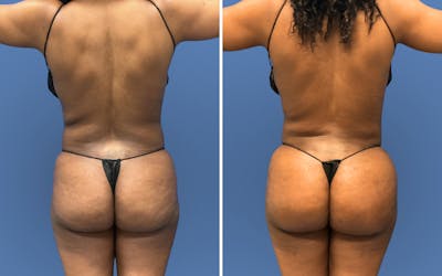 Brazilian Butt Lift Before & After Gallery - Patient 227790 - Image 1
