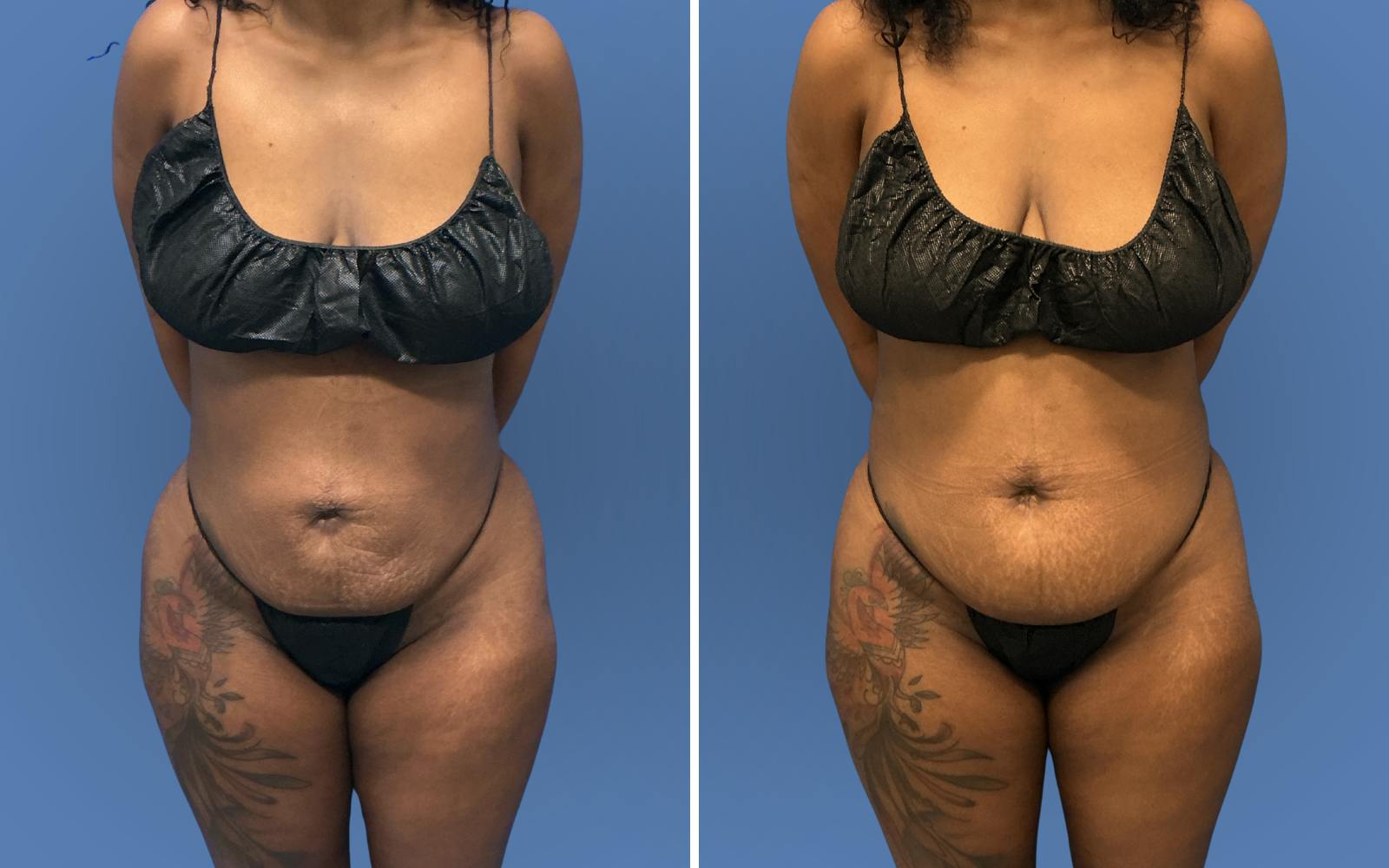 Brazilian Butt Lift Before & After Gallery - Patient 227790 - Image 2