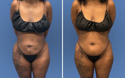 Liposuction Before & After Gallery - Patient 422609 - Image 1