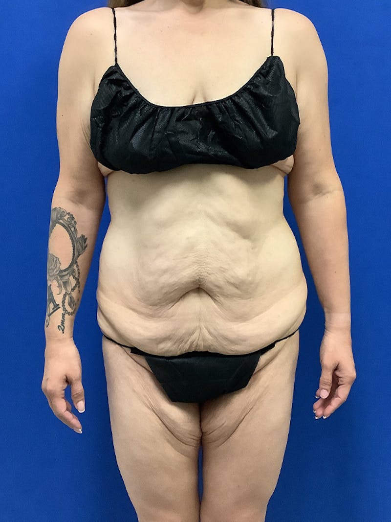 Weight Loss Before & After Gallery - Patient 261135 - Image 1