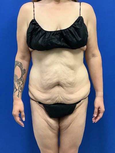 Weight Loss Before & After Gallery - Patient 261135 - Image 1