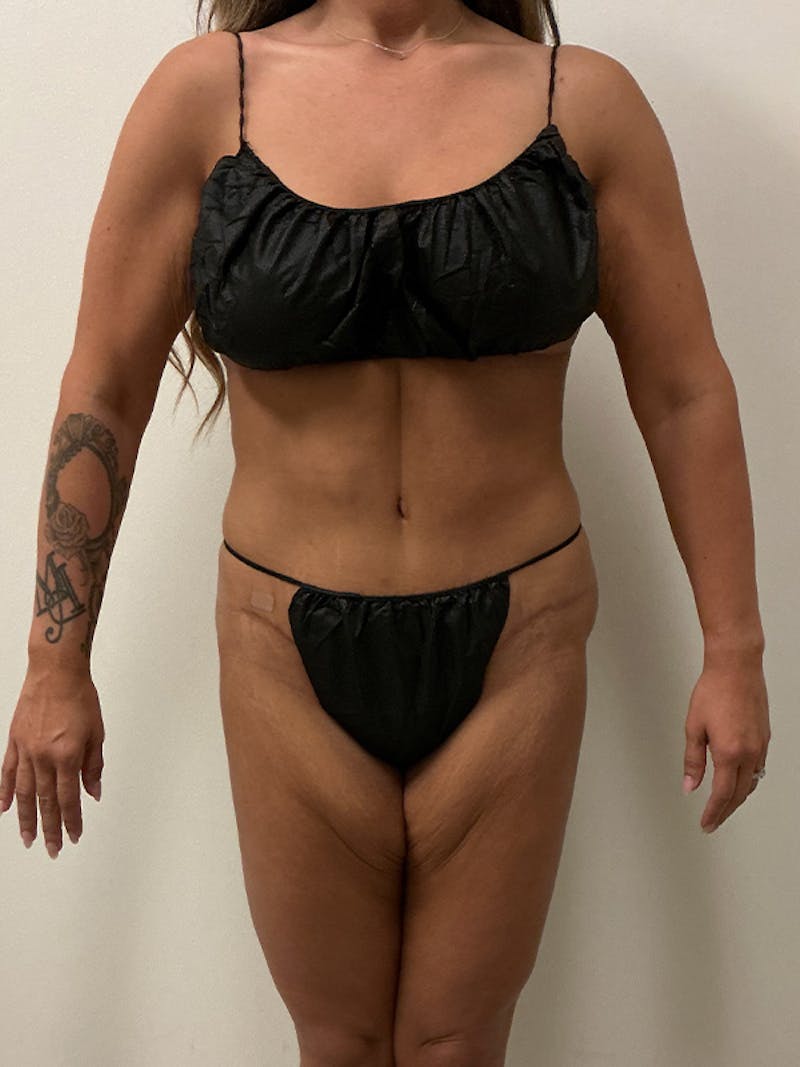 Weight Loss Before & After Gallery - Patient 261135 - Image 2