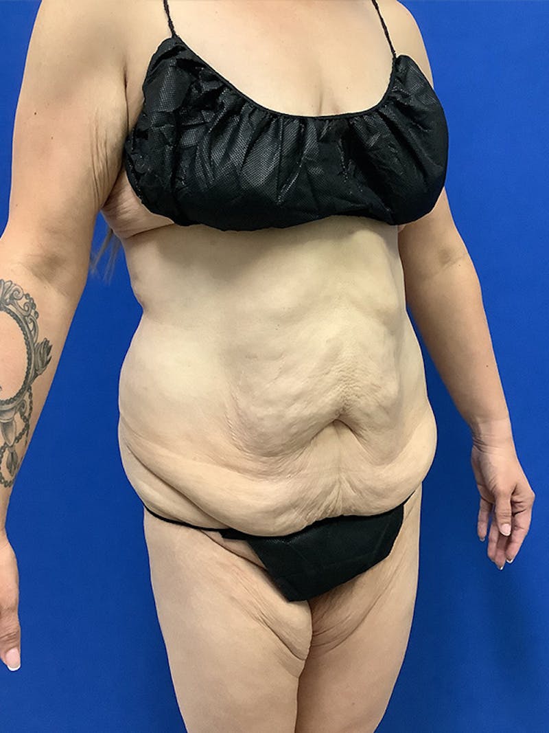 Weight Loss Before & After Gallery - Patient 261135 - Image 3