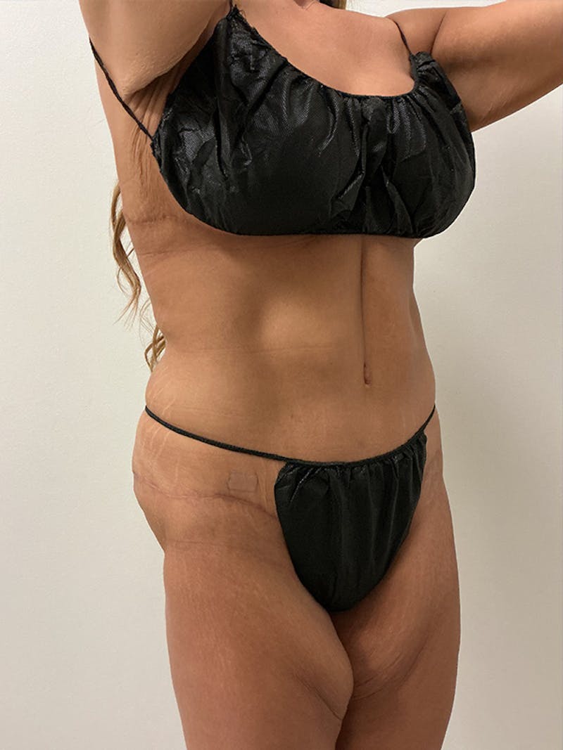 Weight Loss Before & After Gallery - Patient 261135 - Image 4