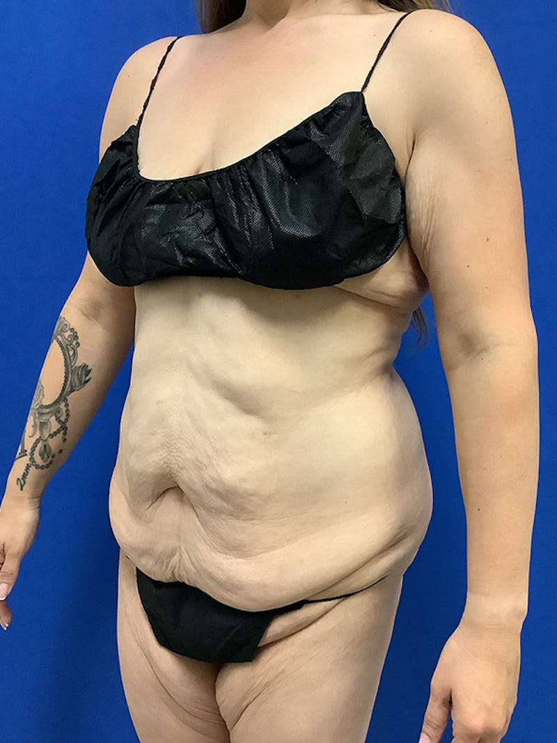 Weight Loss Before & After Gallery - Patient 261135 - Image 7