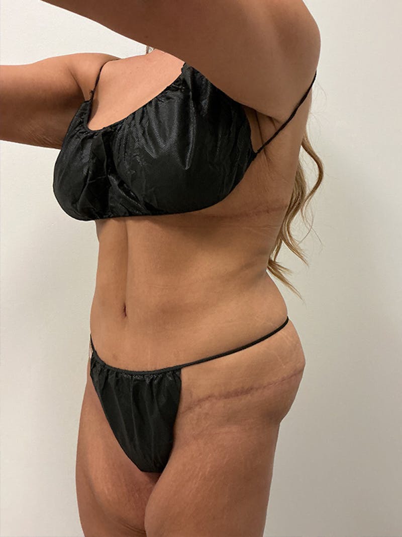 Weight Loss Before & After Gallery - Patient 261135 - Image 8