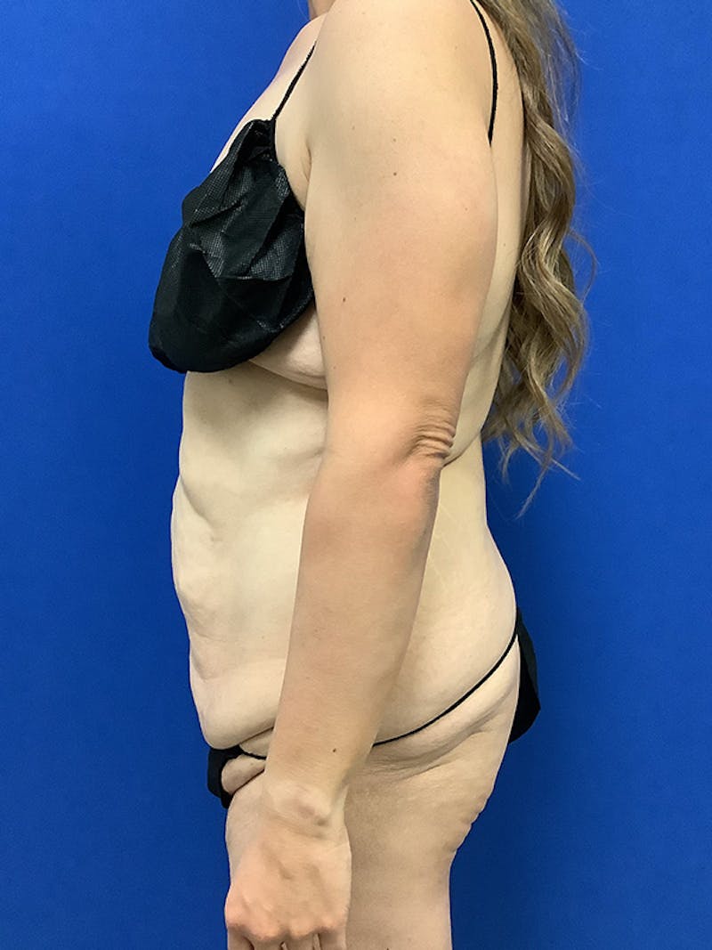 Weight Loss Before & After Gallery - Patient 261135 - Image 9