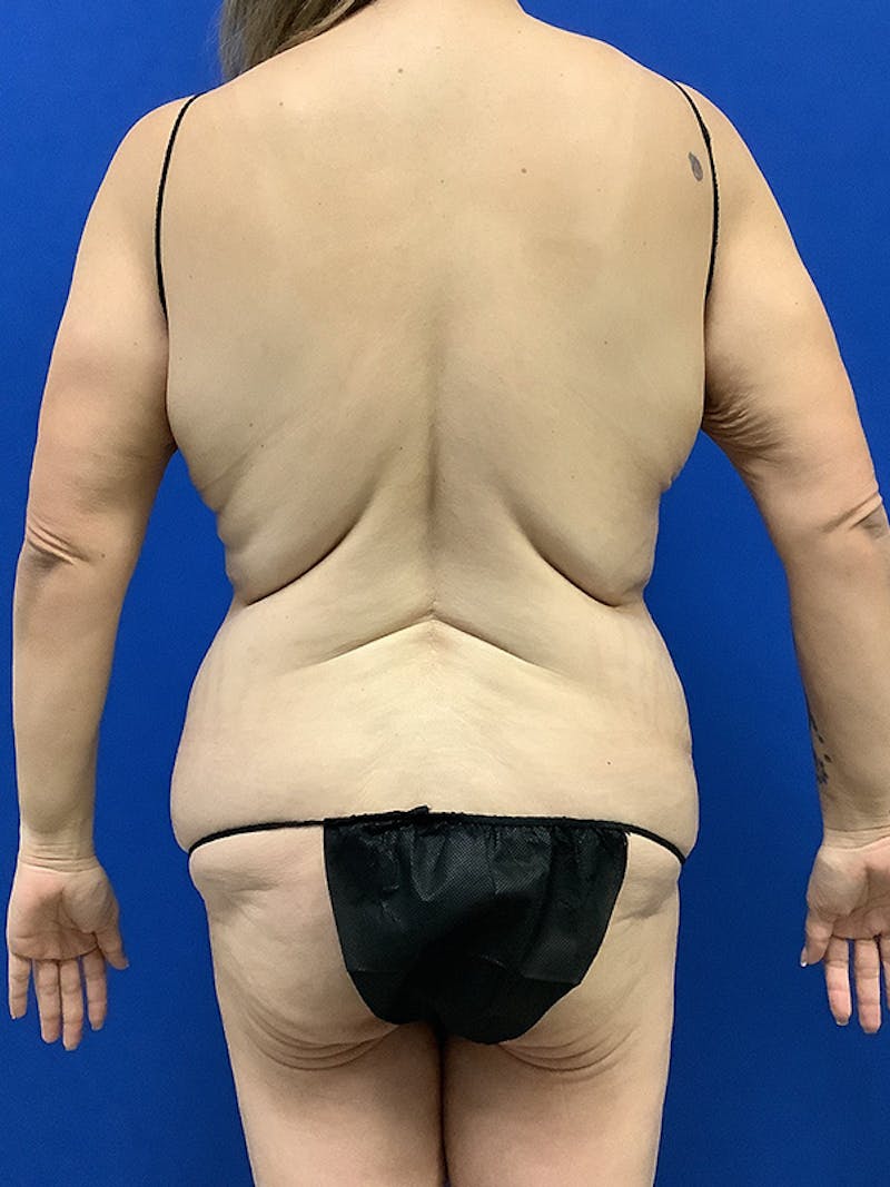 Weight Loss Before & After Gallery - Patient 261135 - Image 11