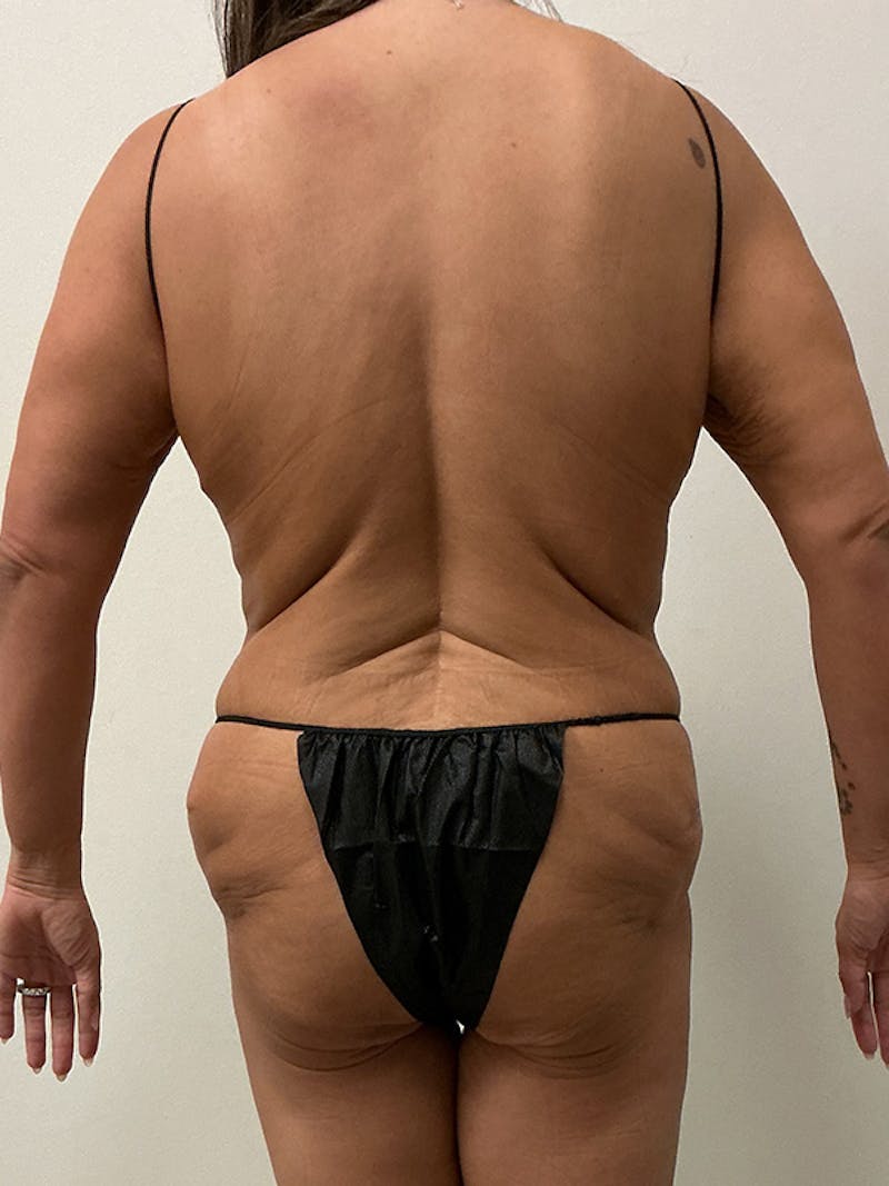 Weight Loss Before & After Gallery - Patient 261135 - Image 12